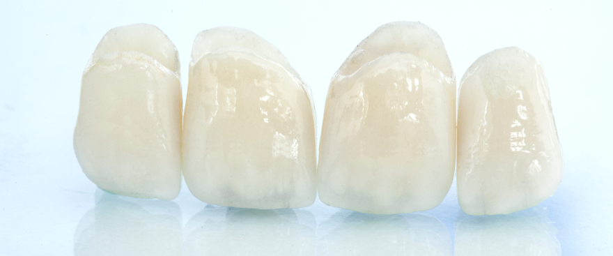 つめ物・かぶせ物