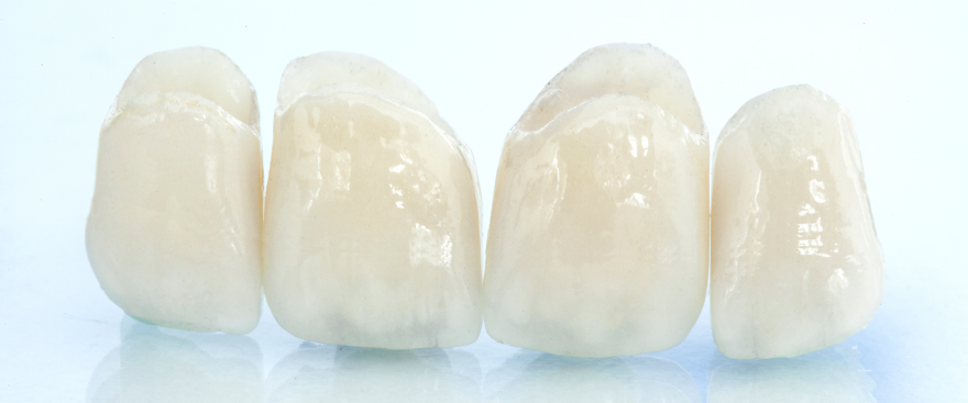 つめ物・かぶせ物